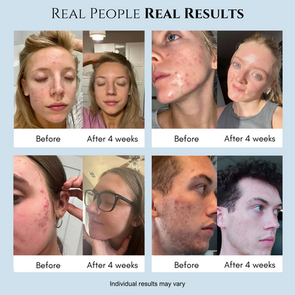 The DermaVac: Advanced Pore Vacuum by Vedora™
